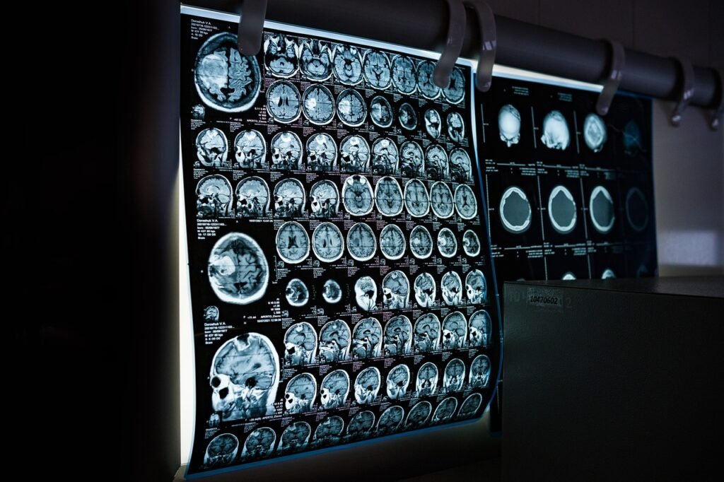 A grayscale MRI scan of a human head and brain, representing a coin-sized brain implant that Coherence Neuro says can detect and stimulate tumors such as glioblastoma