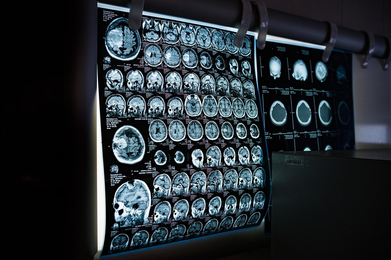 A grayscale MRI scan of a human head and brain, representing a coin-sized brain implant that Coherence Neuro says can detect and stimulate tumors such as glioblastoma